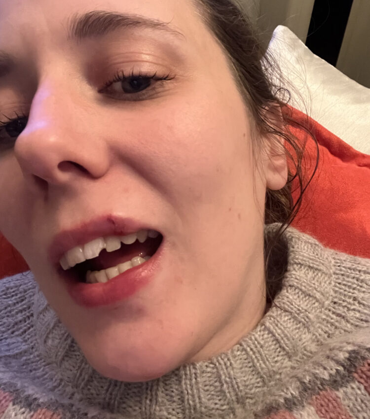 A chipped front tooth, caused by an kickbike accident.