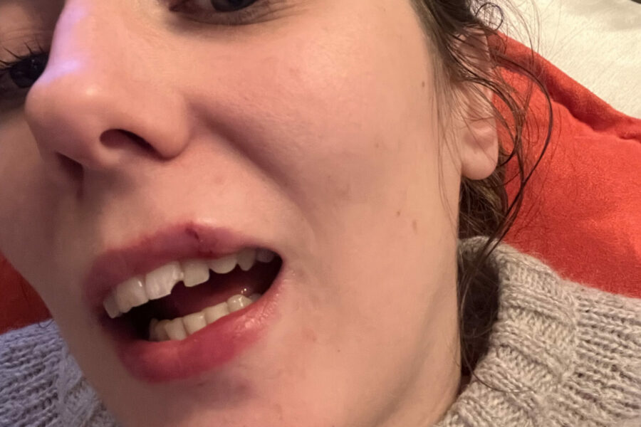 En brukket tann på grunn av en ulykke på en kickbike